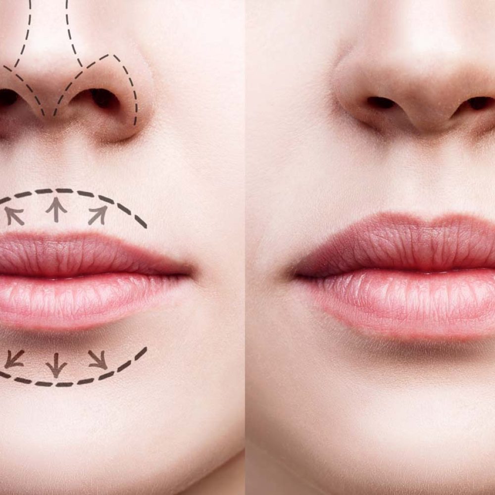 aumento-de-labios-aumento-de-labios-precio-aumento-de-labios-con-acido-hialuronico