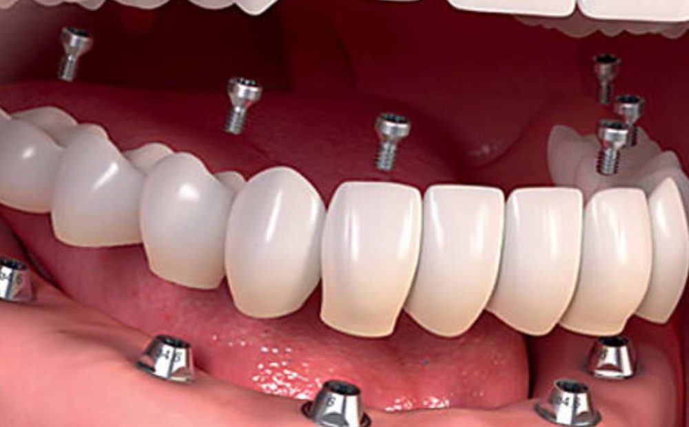 protesis sobre implantes